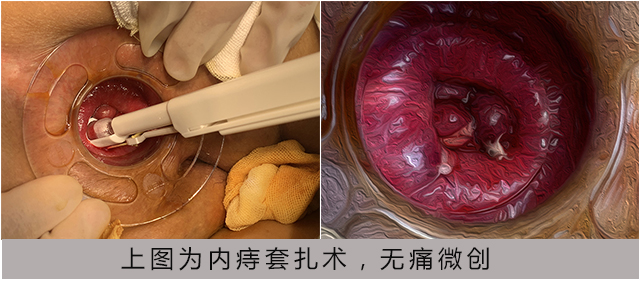 1641807738809759.jpg 內(nèi)痔套扎術(shù).jpg