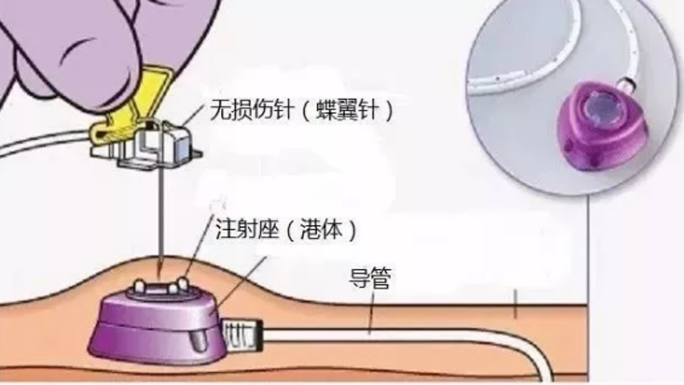 多學(xué)科協(xié)作破高齡治療難題，輸液港技術(shù)啟精準醫(yī)療新篇--太原市第七人民醫(yī)院以創(chuàng)新實踐守護患者健康